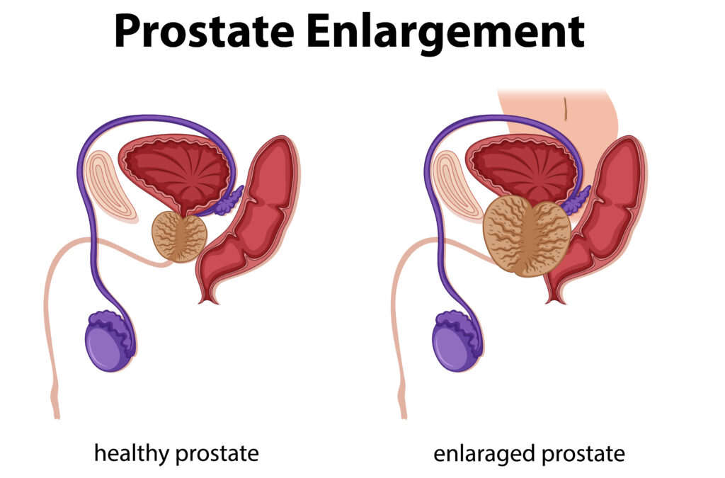 Healthy vs. enlarged prostate illustration highlighting male reproductive system changes and health awareness.