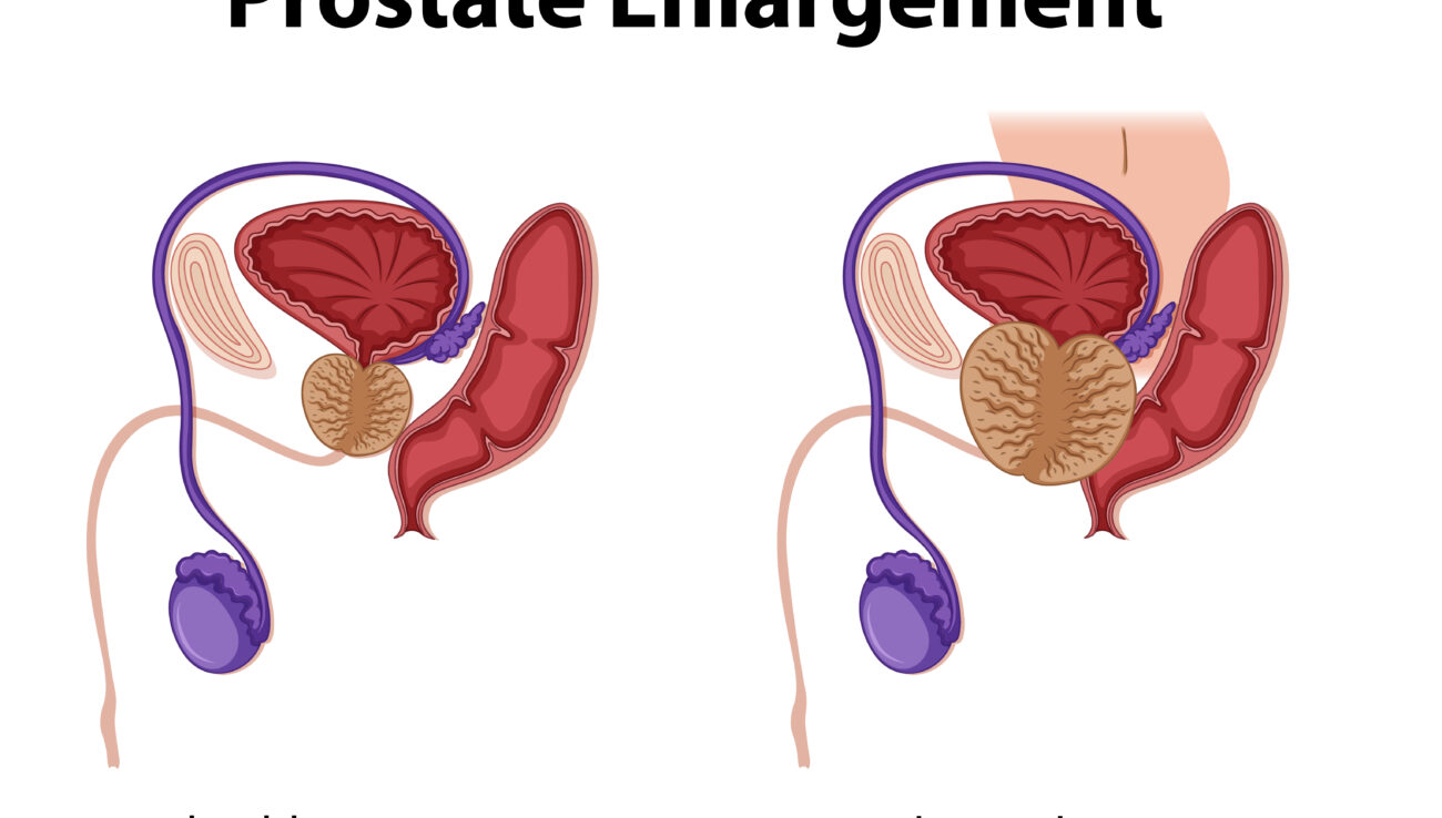 Healthy vs. enlarged prostate illustration highlighting male reproductive system changes and health awareness.