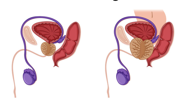 Ilustración de próstata sana frente a próstata agrandada que destaca los cambios del aparato reproductor masculino y la concienciación sobre la salud.