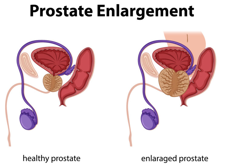 Illustration av frisk respektive förstorad prostata som belyser förändringar i det manliga reproduktionssystemet och hälsokunskap.