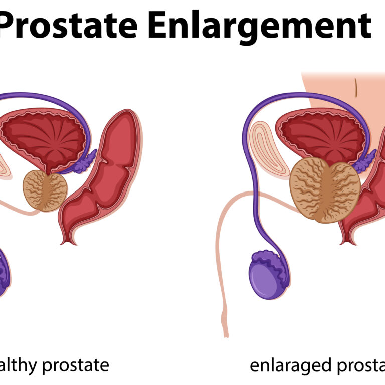 Healthy vs. enlarged prostate illustration highlighting male reproductive system changes and health awareness.