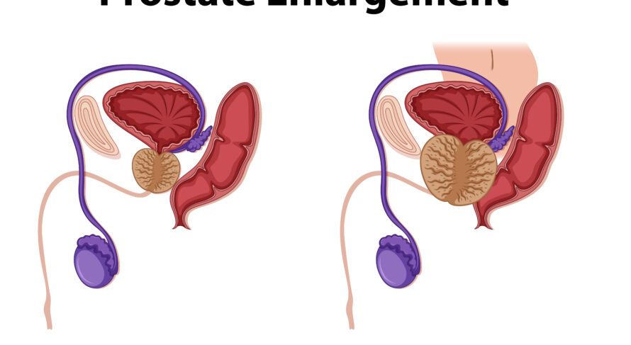 Healthy vs. enlarged prostate illustration highlighting male reproductive system changes and health awareness.