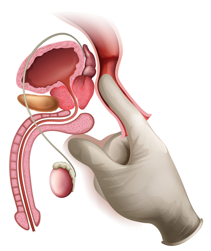 Anatomical illustration of the male reproductive system, including prostate, bladder, and penis.